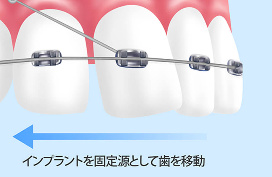 インプラント矯正