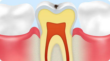 CO初期のむし歯