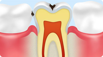 C1エナメル質のむし歯