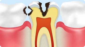 C2象牙質のむし歯