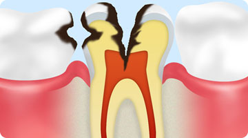 C3神経に達したむし歯