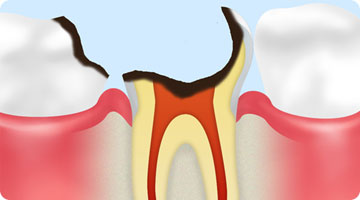 C4歯根に達したむし歯