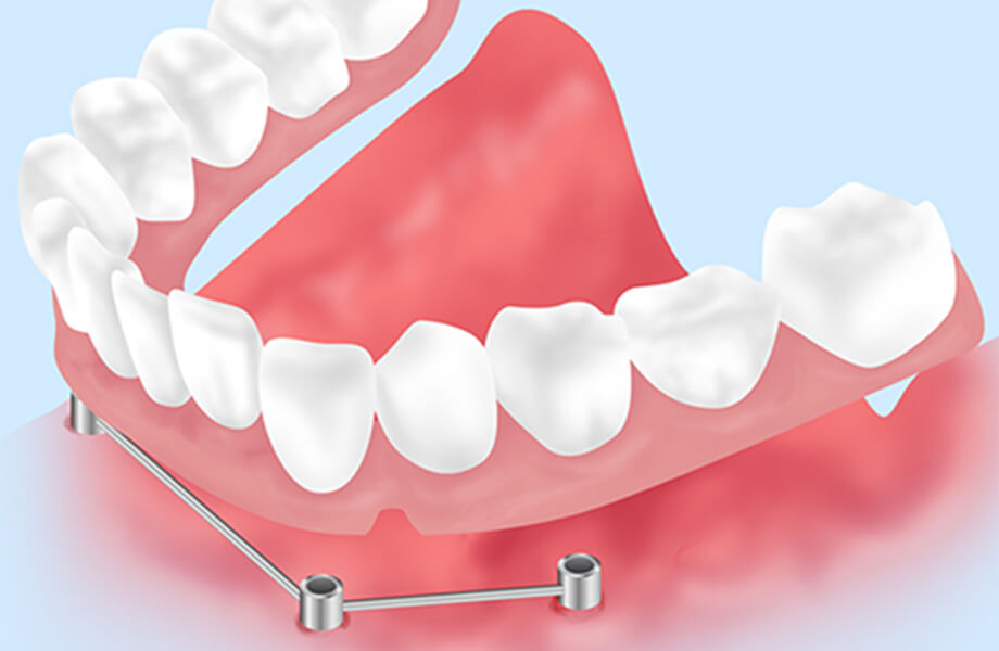 インプラントオーバーデンチャー