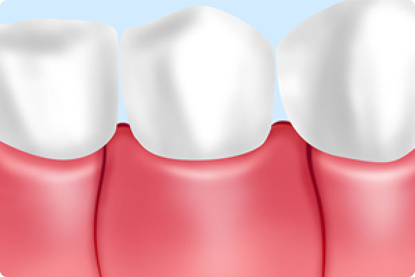 歯周外科治療（フラップ手術）