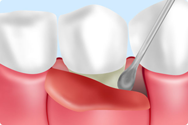 歯周外科治療（フラップ手術）