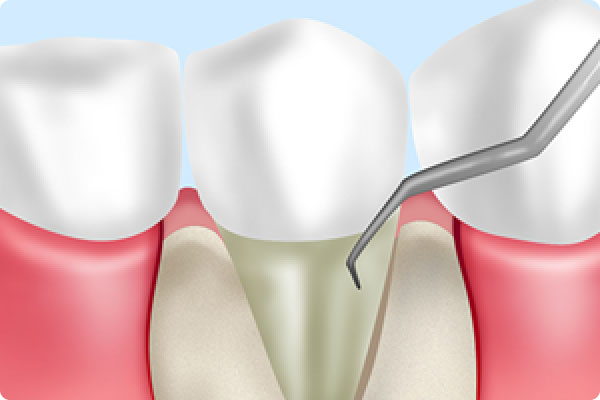 歯周外科治療（フラップ手術）