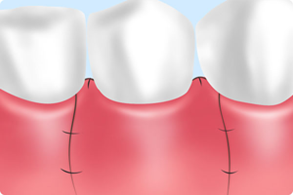 歯周外科治療（フラップ手術）
