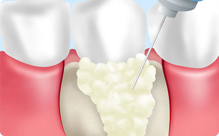 再生療法　リグロスによる歯周再生療法
